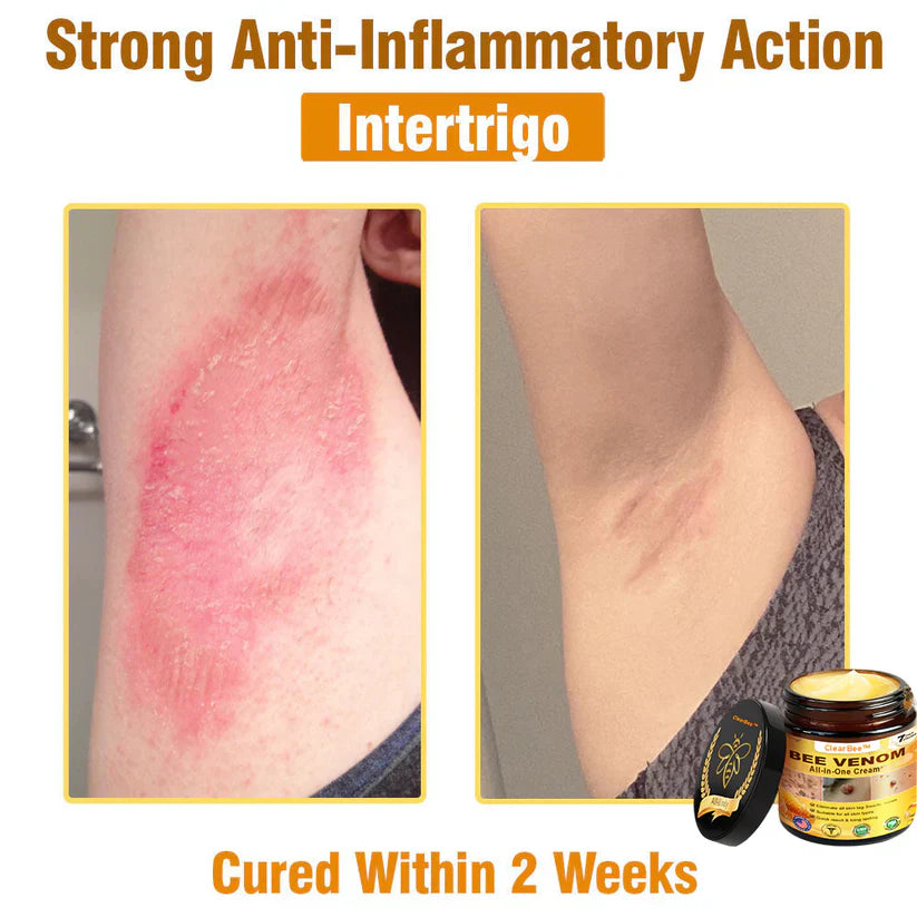🔥FDA Approved: Bee Venom Skin Restoration Cream — 🔥Limited Time 80% OFF🔥