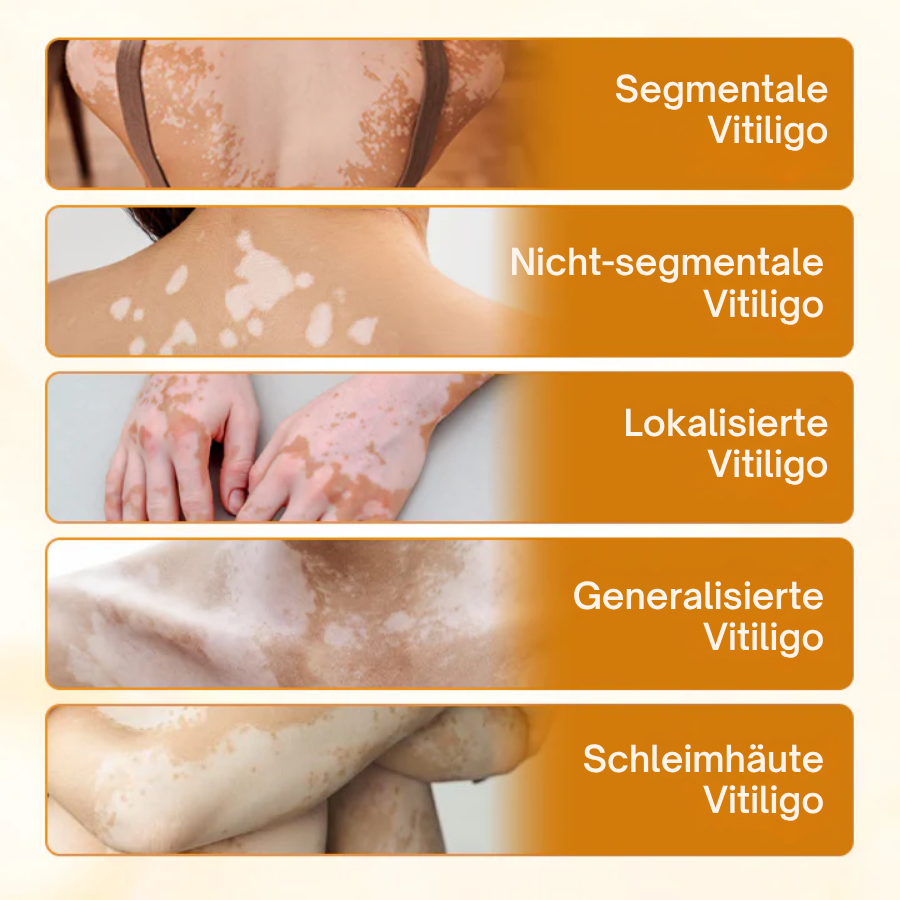 💁🏻♀️Oveallgo® VitiClear Pro Cream🌱 – 🔬Effectively reduces Vitiligo by 90% in 3 weeks