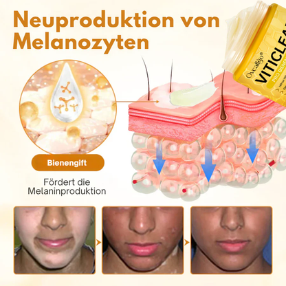 💁🏻‍♀️Oveallgo® VitiClear Pro Cream🌱 – 🔬Effectively reduces Vitiligo by 90% in 3 weeks