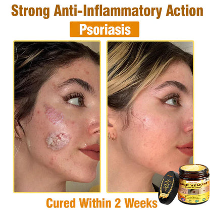 🔥FDA Approved:  Bee Venom Skin Restoration Cream — 🔥Limited Time 80% OFF🔥