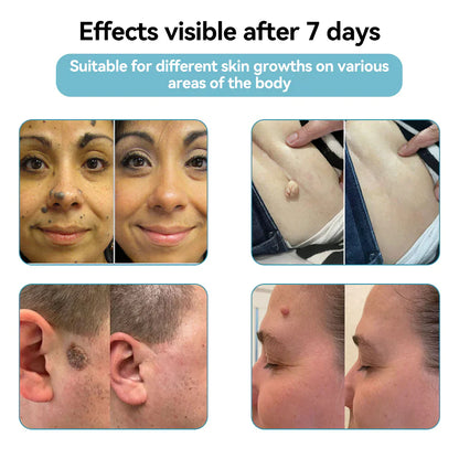 ☂DerMultak® VelvetSkin+Special 🥇All-in-One Laser Eraser Pen🖊️(🛸Powered by CO₂ laser technology – effectively removes moles, warts, skin tags, pigmentation spots, and other skin imperfections)