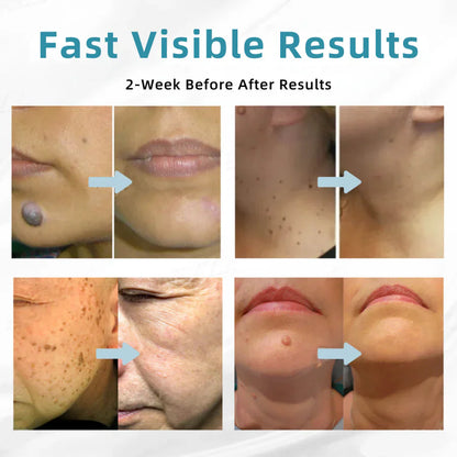 ☂DerMultak® VelvetSkin+Special 🥇All-in-One Laser Eraser Pen🖊️(🛸Powered by CO₂ laser technology – effectively removes moles, warts, skin tags, pigmentation spots, and other skin imperfections)