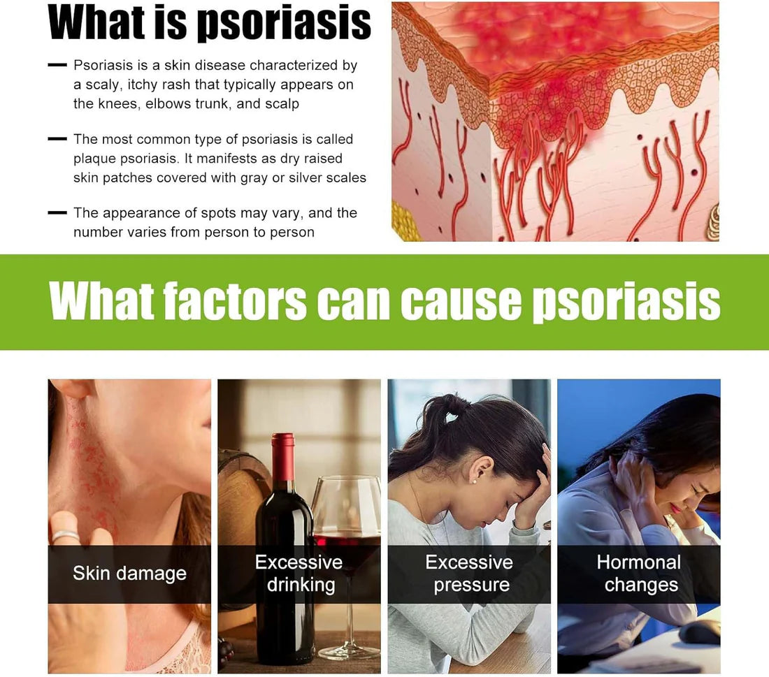 Todahof Bienengift Psoriasis Behandlungscreme, Todahof Bienengift Psoriasis Behandlungscreme, Todahof Bienengift Creme, Psoriasis Creme, Bienengift Psoriasis Behandlungscreme (3 Stück)