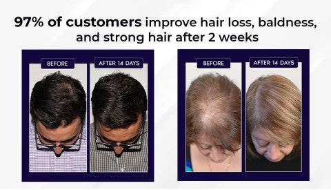🌿Last day offer – 50% off🌿 HZA™ Hair Growth Spray, pure natural plant extracts without chemical additives