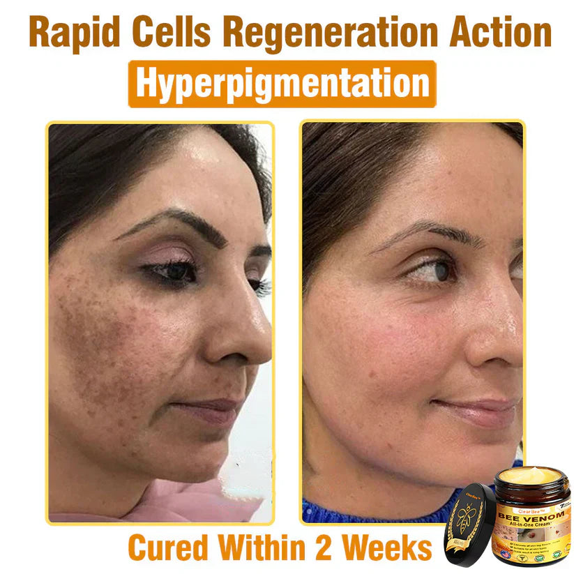 🔥FDA Approved:  Bee Venom Skin Restoration Cream — 🔥Limited Time 80% OFF🔥