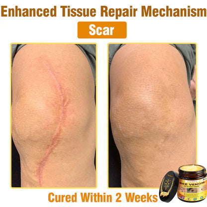 🔥FDA Approved:  Bee Venom Skin Restoration Cream — 🔥Limited Time 80% OFF🔥