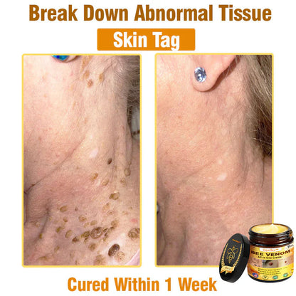 🔥FDA Approved:  Bee Venom Skin Restoration Cream — 🔥Limited Time 80% OFF🔥