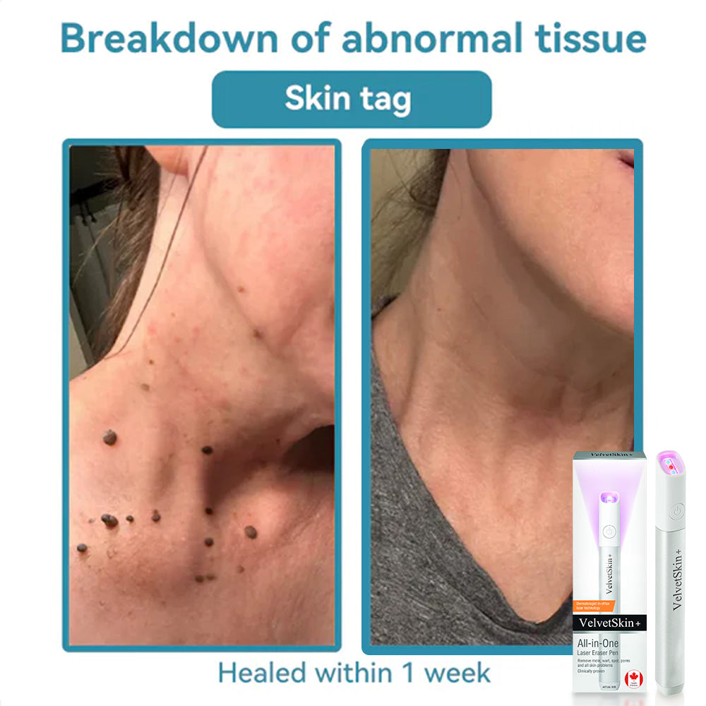 ☂DerMultak® VelvetSkin+Special 🥇All-in-One Laser Eraser Pen🖊️(🛸Powered by CO₂ laser technology – effectively removes moles, warts, skin tags, pigmentation spots, and other skin imperfections)