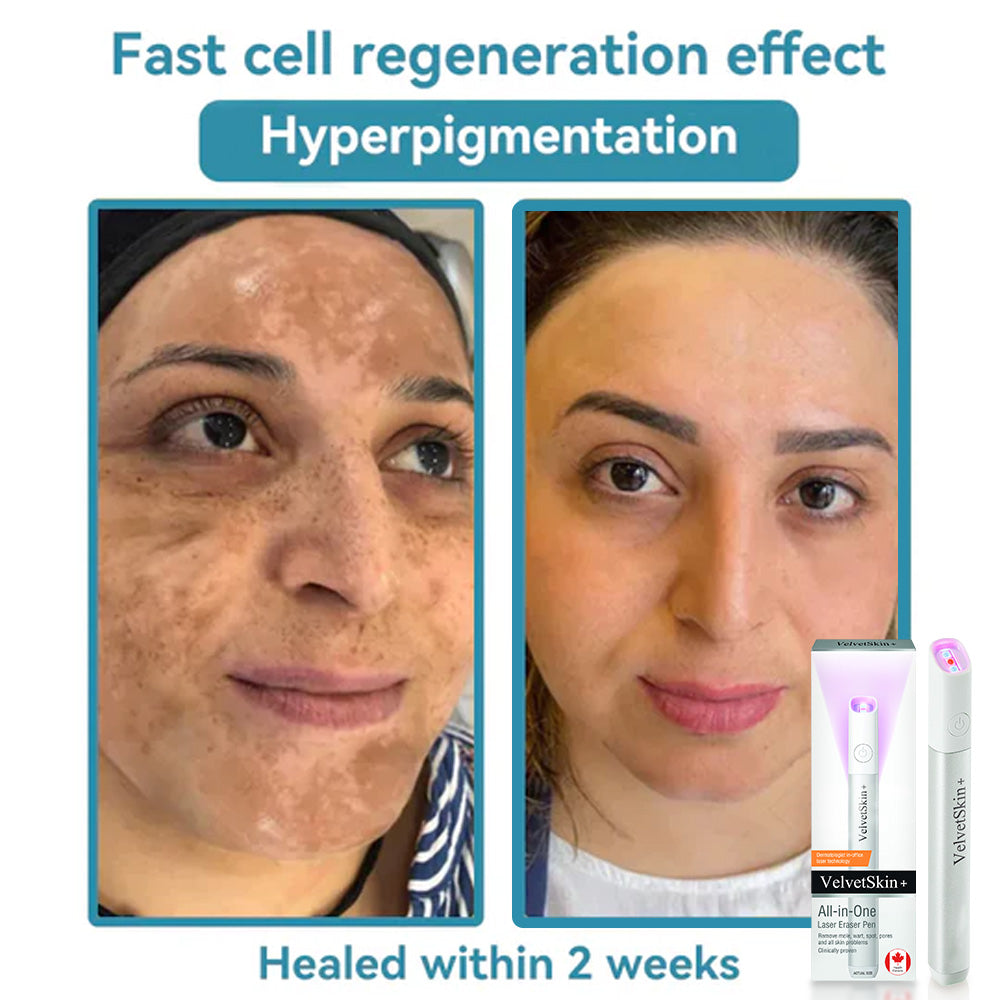 ☂DerMultak® VelvetSkin+Special 🥇All-in-One Laser Eraser Pen🖊️(🛸Powered by CO₂ laser technology – effectively removes moles, warts, skin tags, pigmentation spots, and other skin imperfections)