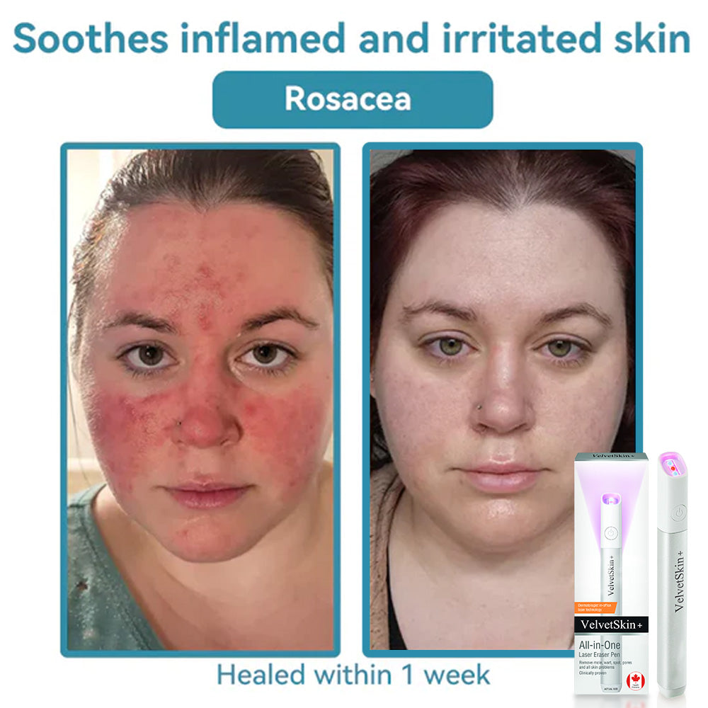 ☂DerMultak® VelvetSkin+Special 🥇All-in-One Laser Eraser Pen🖊️(🛸Powered by CO₂ laser technology – effectively removes moles, warts, skin tags, pigmentation spots, and other skin imperfections)