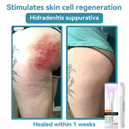 ☂DerMultak® VelvetSkin+Special 🥇All-in-One Laser Eraser Pen🖊️(🛸Powered by CO₂ laser technology – effectively removes moles, warts, skin tags, pigmentation spots, and other skin imperfections)